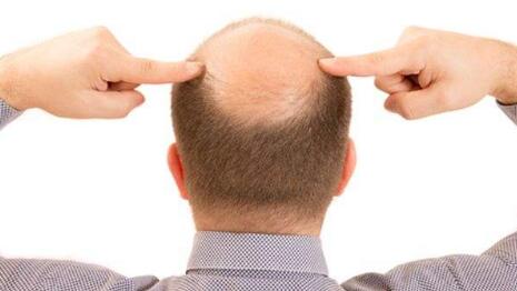 男性秃头的原因有哪些 怎么去预防脱发问题