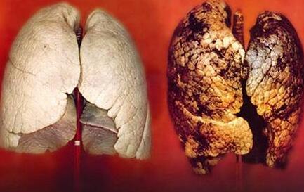 女性白领肺部检查能够使用红外扫描