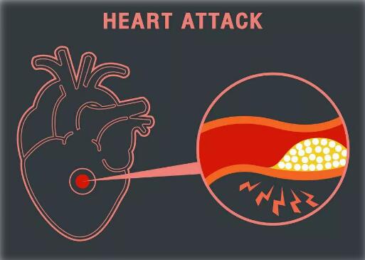 胸闷、心悸、呼吸困难......冠心病可能正在危害你的健康，警惕猝死风险