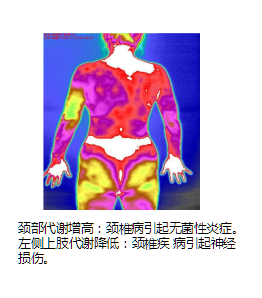 奕诗集团红外热成像筛查颈椎病的案例