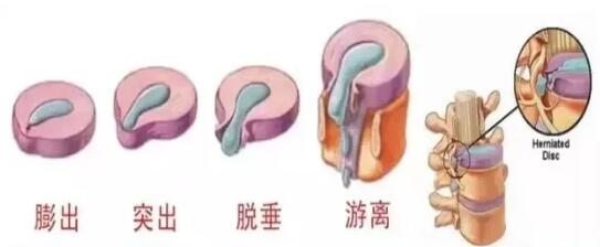 腰椎间盘疾病示意图