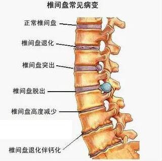腰椎间盘类疾病示意图